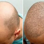 Cost of hair transplant in Turkey