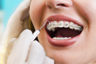 Braces in Berlin: Finding the Right Orthodontist for You