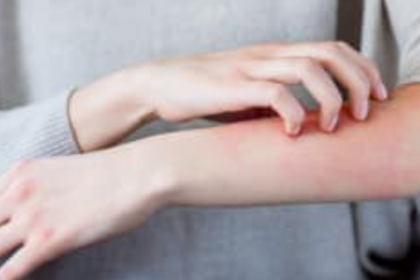 Rash