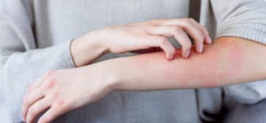 Rash