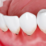Unraveling the Mystery: Why Is My Gum Swollen Around One Tooth in the Back