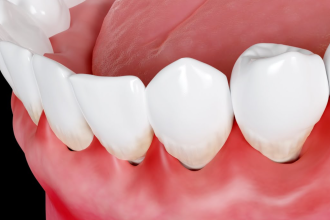 Unraveling the Mystery: Why Is My Gum Swollen Around One Tooth in the Back