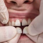 From Myth to Reality: The Truth Behind What Really Happens When a Tooth Falls Out