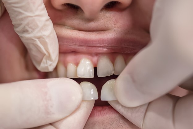 From Myth to Reality: The Truth Behind What Really Happens When a Tooth Falls Out