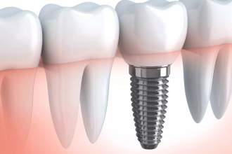 Understanding the Benefits of Dental Implants