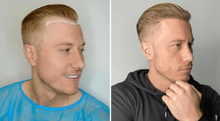 Understanding the Cost of a Hair Transplant in Dublin