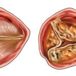 Navigating Aortic Valve Stenosis Treatment in Germany: A Comprehensive Guide for Patients