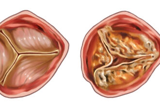 Navigating Aortic Valve Stenosis Treatment in Germany: A Comprehensive Guide for Patients