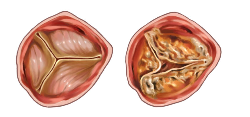 Navigating Aortic Valve Stenosis Treatment in Germany: A Comprehensive Guide for Patients