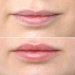The Ultimate Guide to Lip Fillers: Everything You Need to Know