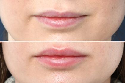 The Ultimate Guide to Lip Fillers: Everything You Need to Know