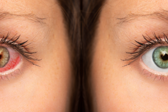 7 Causes of Dry Eye in the Morning