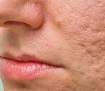Innovative Solutions for Acne Scars: Breaking Down Treatment Options