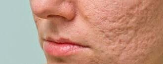 Innovative Solutions for Acne Scars: Breaking Down Treatment Options