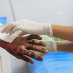 Common Challenges in Burn Injury Claims