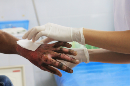 Common Challenges in Burn Injury Claims