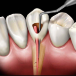 Understanding Root Canal Treatment: Do You Need It