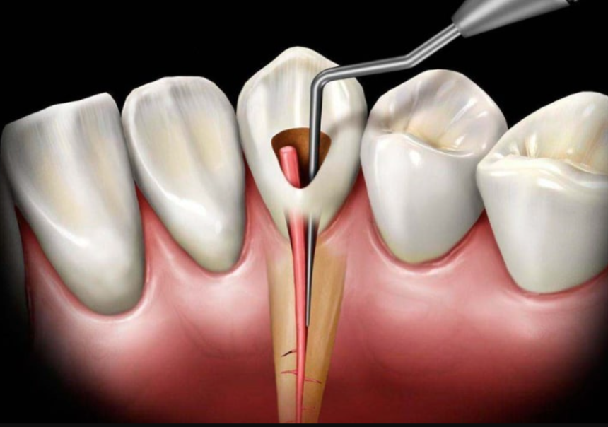 Understanding Root Canal Treatment: Do You Need It