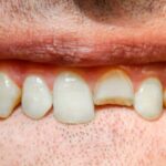 Top 5 Innovations in Managing Sports Injuries to Teeth in Irving, TX