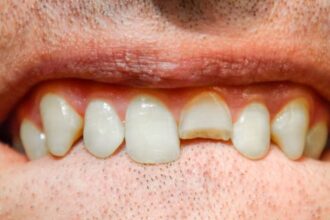 Top 5 Innovations in Managing Sports Injuries to Teeth in Irving, TX