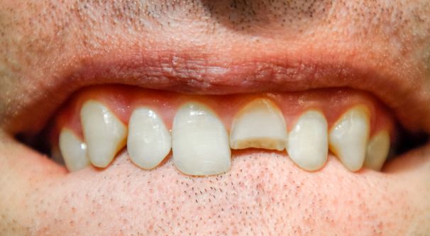 Top 5 Innovations in Managing Sports Injuries to Teeth in Irving, TX