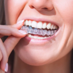 What to Expect When Getting Braces: A Beginner’s Guide
