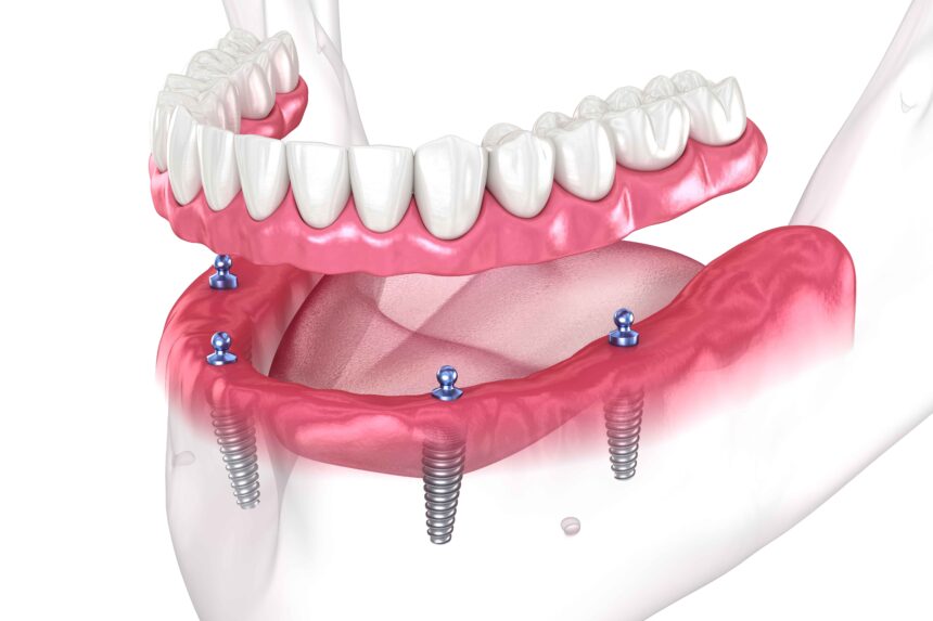 Why All on 4 Implant Costs Vary: Key Influences