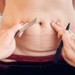 Five Myths About Mommy Makeovers Busted