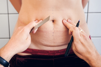 Five Myths About Mommy Makeovers Busted