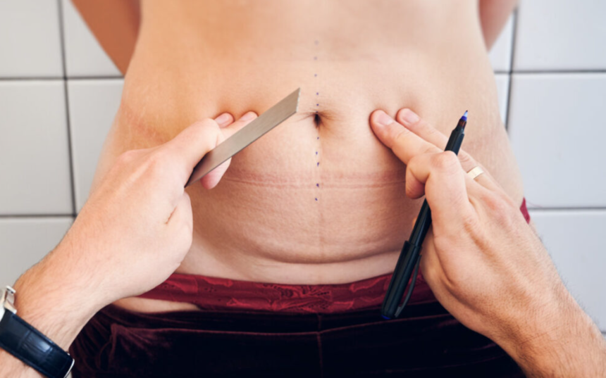 Five Myths About Mommy Makeovers Busted