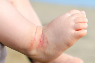 How to Safely Treat Newborn Eczema with the Right Cream