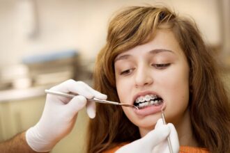 The Benefits of Teeth Alignment for Overall Health