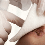 Revolutionizing Stoma Skin Care with Hydrocolloid Sheet Technology