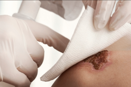 Revolutionizing Stoma Skin Care with Hydrocolloid Sheet Technology