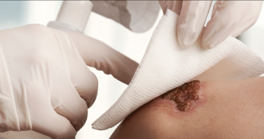 Revolutionizing Stoma Skin Care with Hydrocolloid Sheet Technology