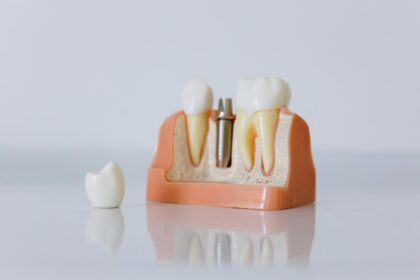 Warning Signs and Aftercare Tips for Dental Implant Success