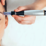 Why Microneedling is Gaining Popularity in Singapore's Aesthetic Clinics