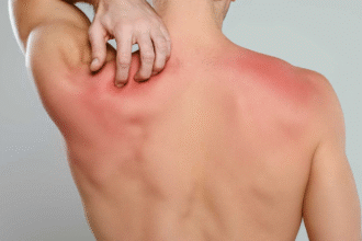 How Thigh Guards Can Prevent Painful Chafing