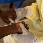 Mpox Not an International Health Emergency