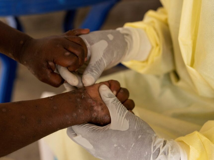Mpox Not an International Health Emergency